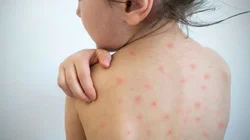 measles_su19_f3c8ff354c