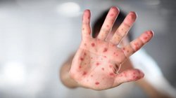 sarampion_mexico_casos_28_muertes_e7400738e2