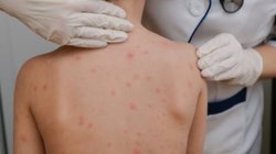 sarampion_nuevo_leon_81cd2a3a1b